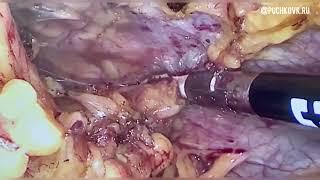Лапароскопия при спаечном процессе в брюшной полости