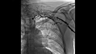 Left Upper Extremity Venogram of Thrombosis of Left Subclavian Vein With Network of Small Veins