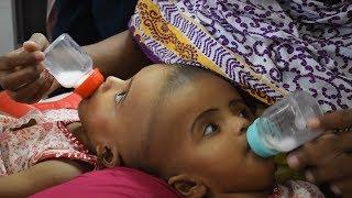 Hope Conjoined twins in Bangladesh to undergo surgery to separate their heads
