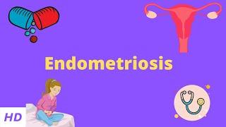 Endometriosis Causes Signs and Symptoms Diagnosis and Treatment.