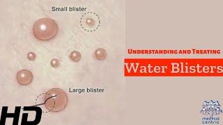 Water Blisters Unveiled Causes Treatment and Prevention