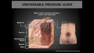 Various Stages of Pressure Ulcers