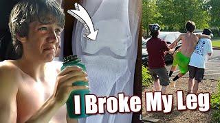 I Broke My Leg 