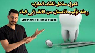 تحول مذهل للفك العلوي رحلة تركيب الأسنان من الألف إلى الياء Upper Jaw Full Rehabilitation