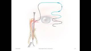 Epiphora   RITLENG+ INTUBATION OISA