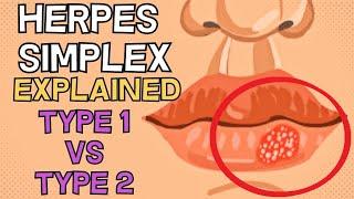 Herpes Simplex - Type 1 vs Type 2 - EXPLAINED IN 2 MINUTES