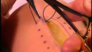 Simple Interrupted Suture with Instrument Tie