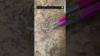 Springy ingrown hair removal #extraction #drpimplepopper #ingrownhairremoval #oddlysatisfying