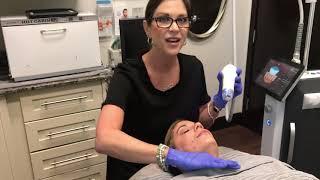 Microneedling with Secret RF